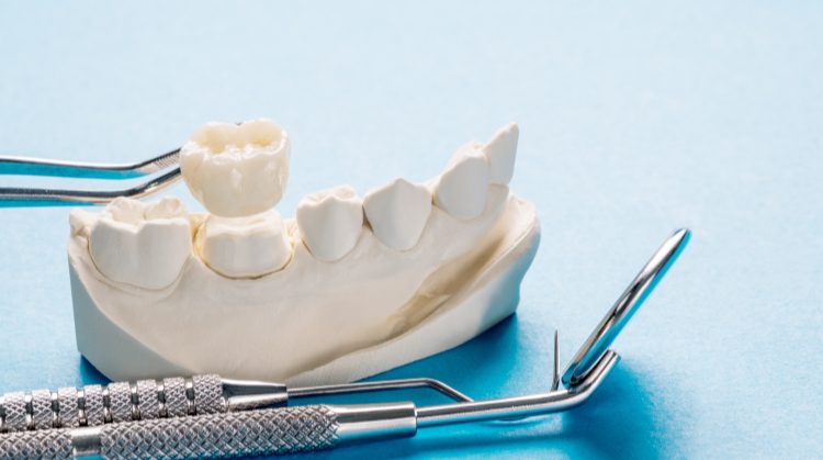 Dental crowns on a tooth model with dental tools.