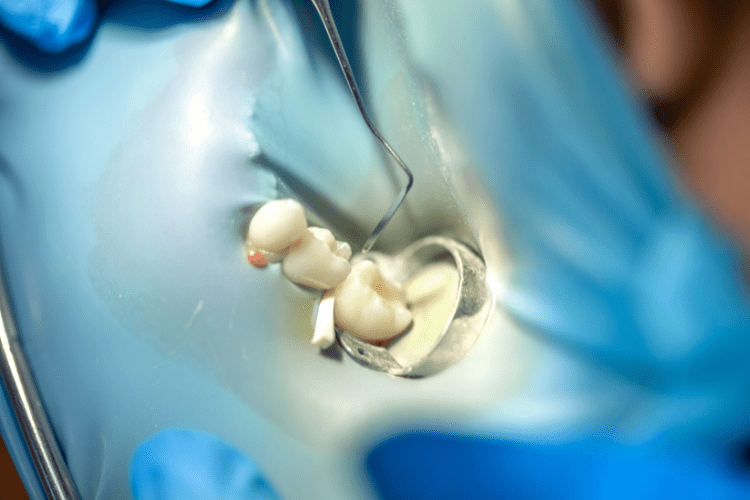 Broken tooth repair